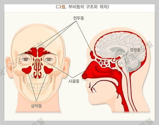 부비동암이란