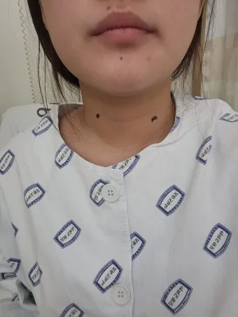 부갑상선기능항진증 수술 후기 2주차 내분비외과 내원 경험담_13