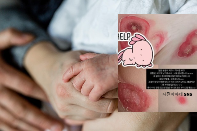 유아 농가진 원인과 증상, 치료법, 주의사항