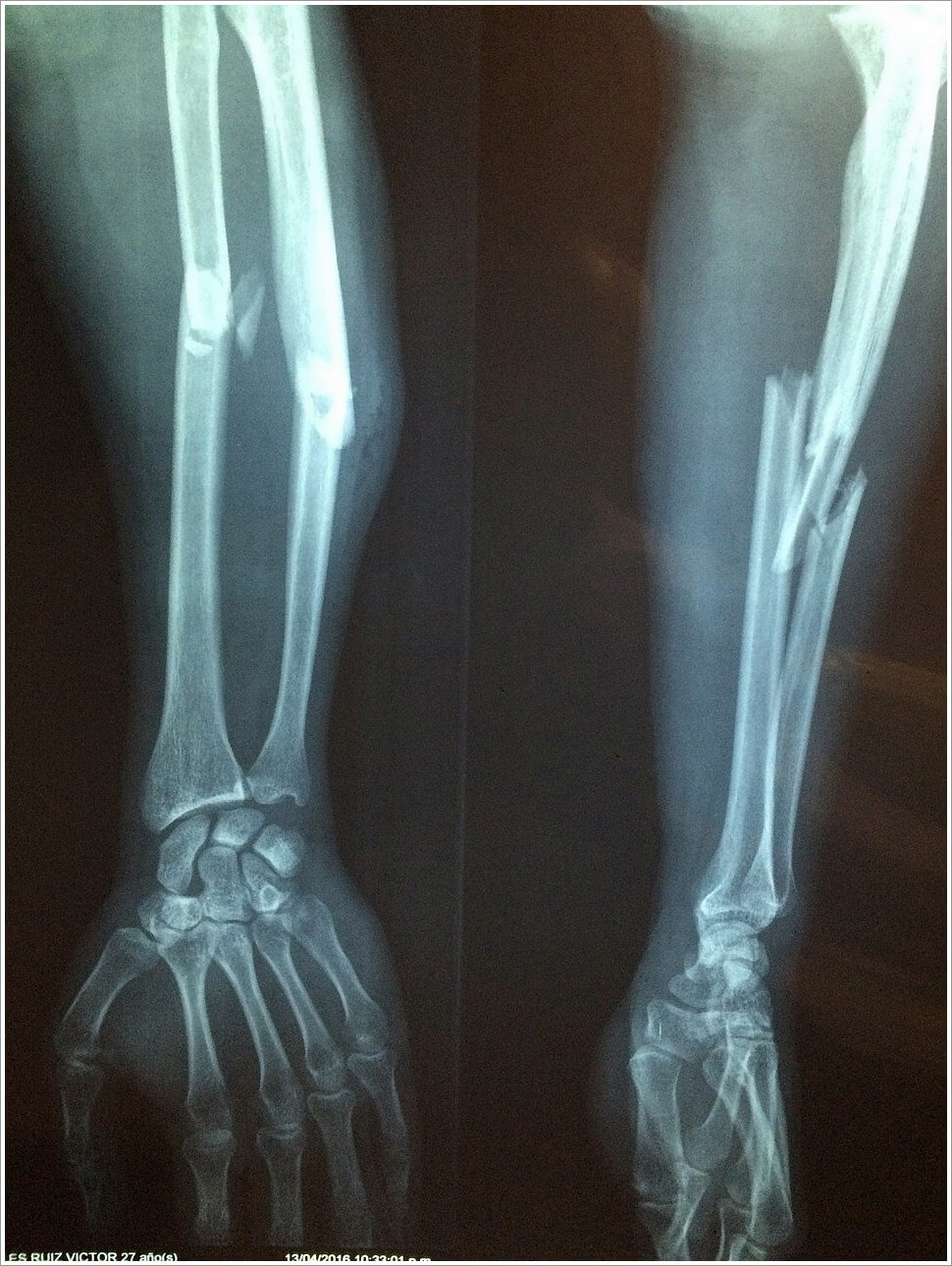 뼈골절에 좋은 음식
