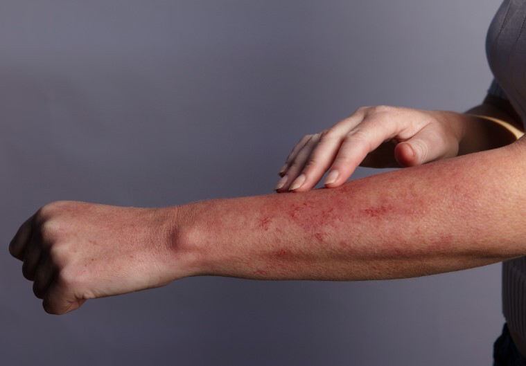 땀띠 치료 가라앉히는 방법 5가지