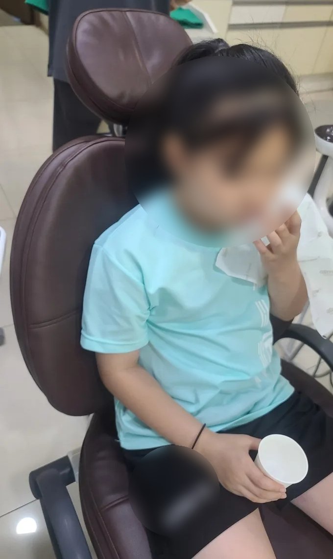 유치 치아 실란트