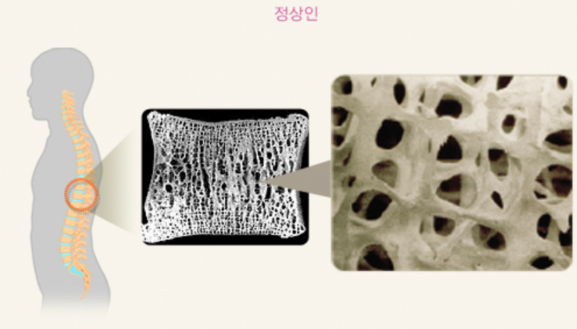 정상인 골밀도