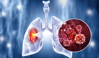 폐암