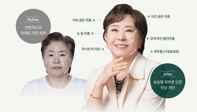 신사역안면거상 미니리프팅가격