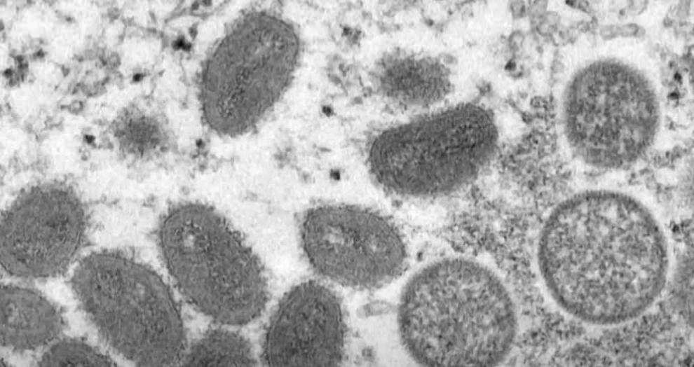 원숭이두창 증상