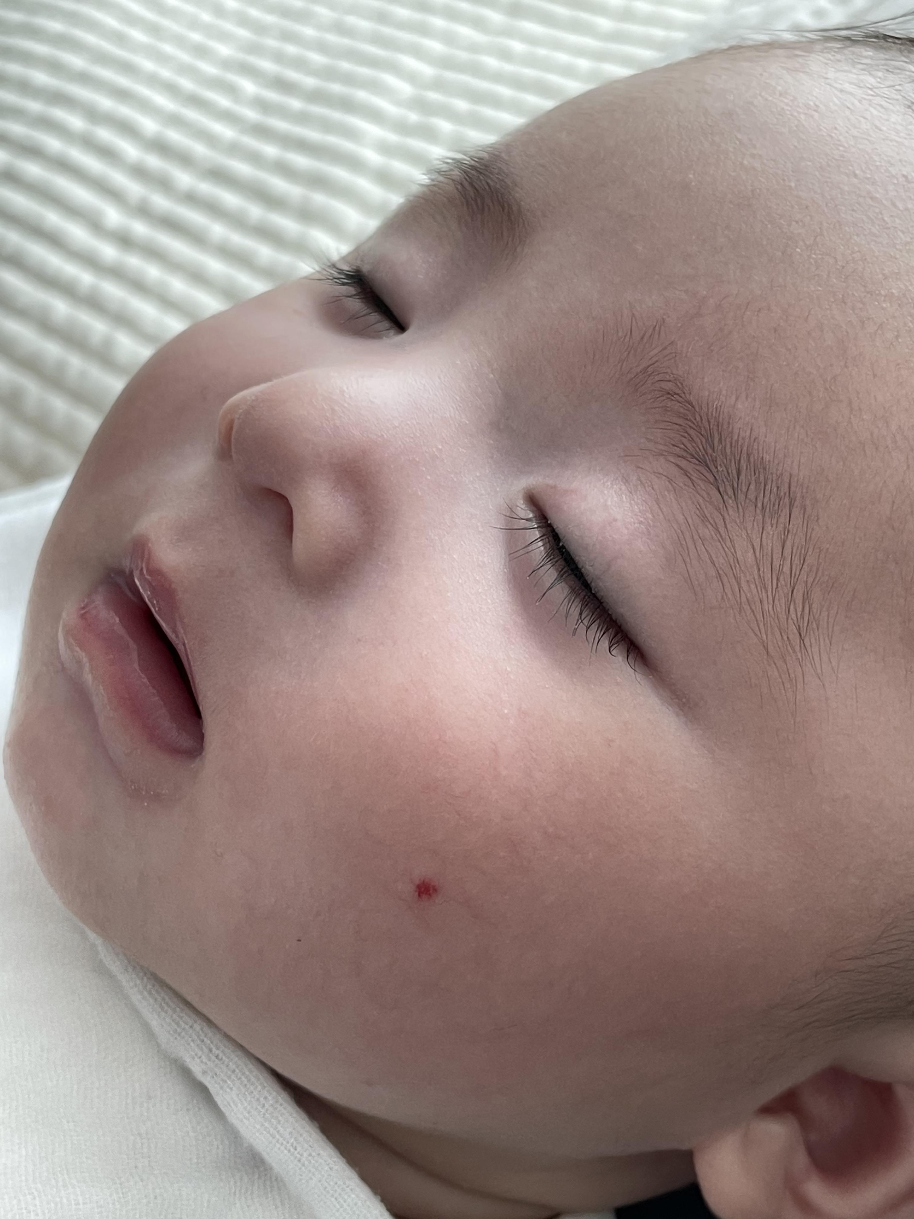 혈관종 에스앤유 피부과