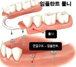 임플란트-틀니-가격