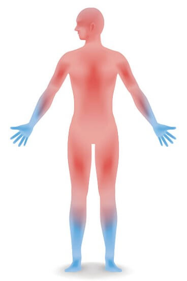 동상증상-궤사 동상증상-혈액순환장애