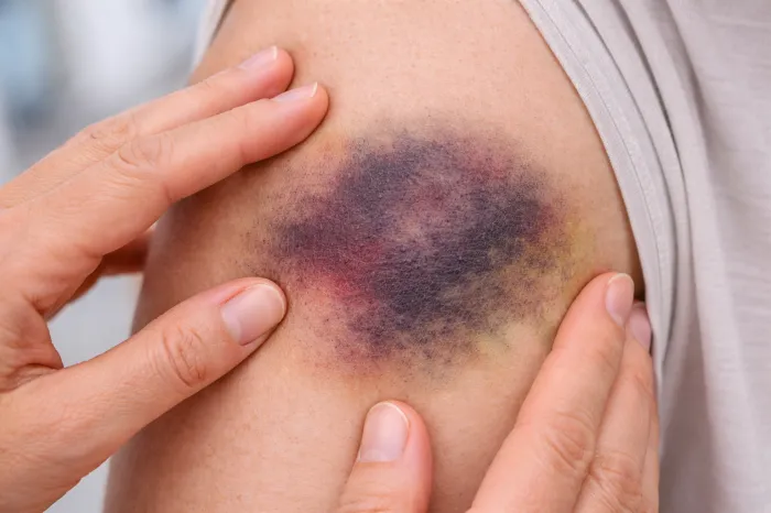 피부에 멍이 잘드는 이유