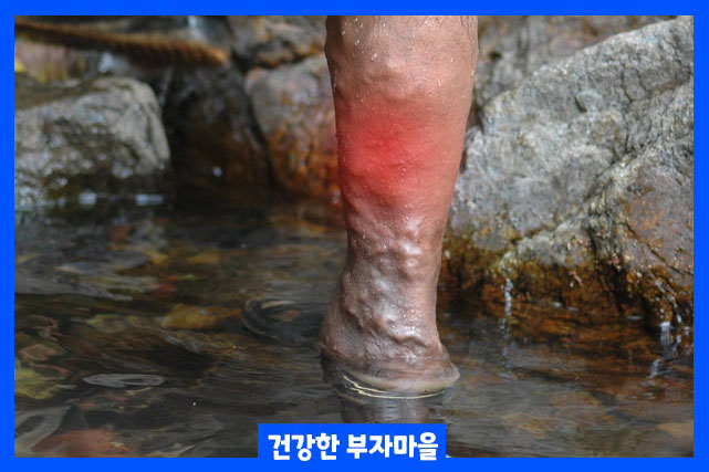 하지정맥류 통증 완화 방법