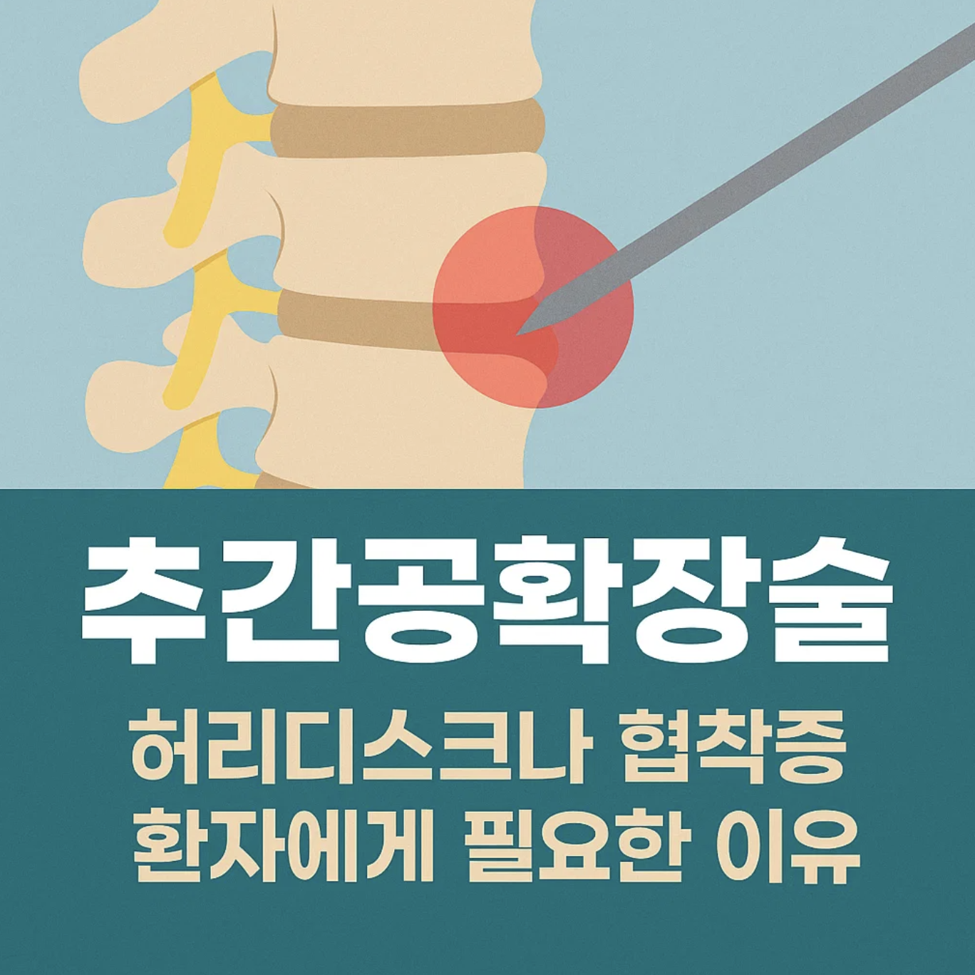 추간공확장술 허리디스크나 협착증 환자에게 필요한 이유