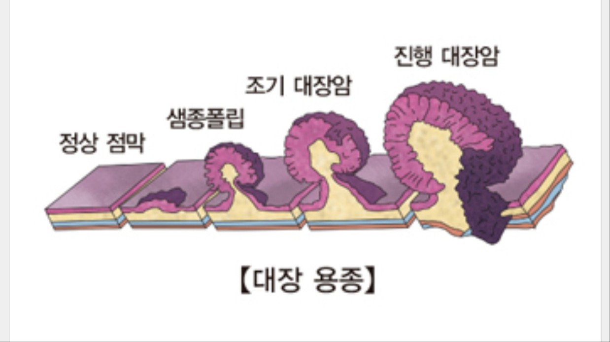 대장용종 사이즈별 정리한 사진