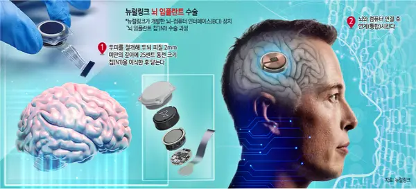 뉴럴링크-뇌 임플란트 수술