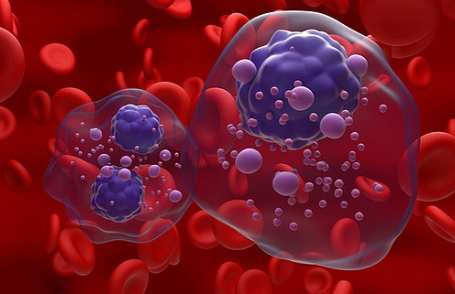 혈액암의 종류별 증상과 치료법