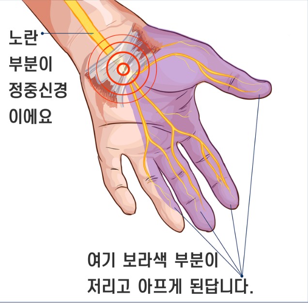 손저림1