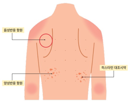 알레르기비염-피부반응시험