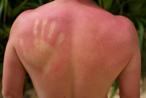 피부 붉은반점 38