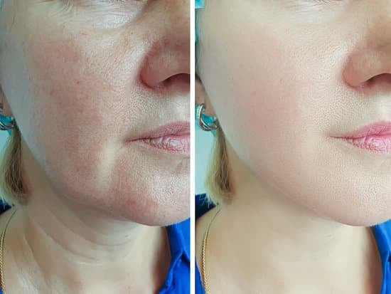 피부과 시술로 주름 개선하기