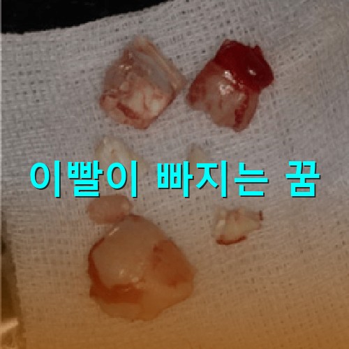 이빨이-다섯개-이상-빠져서-거즈에-올려놓은-모습