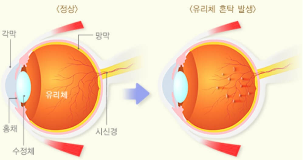 비문증 증상 설명