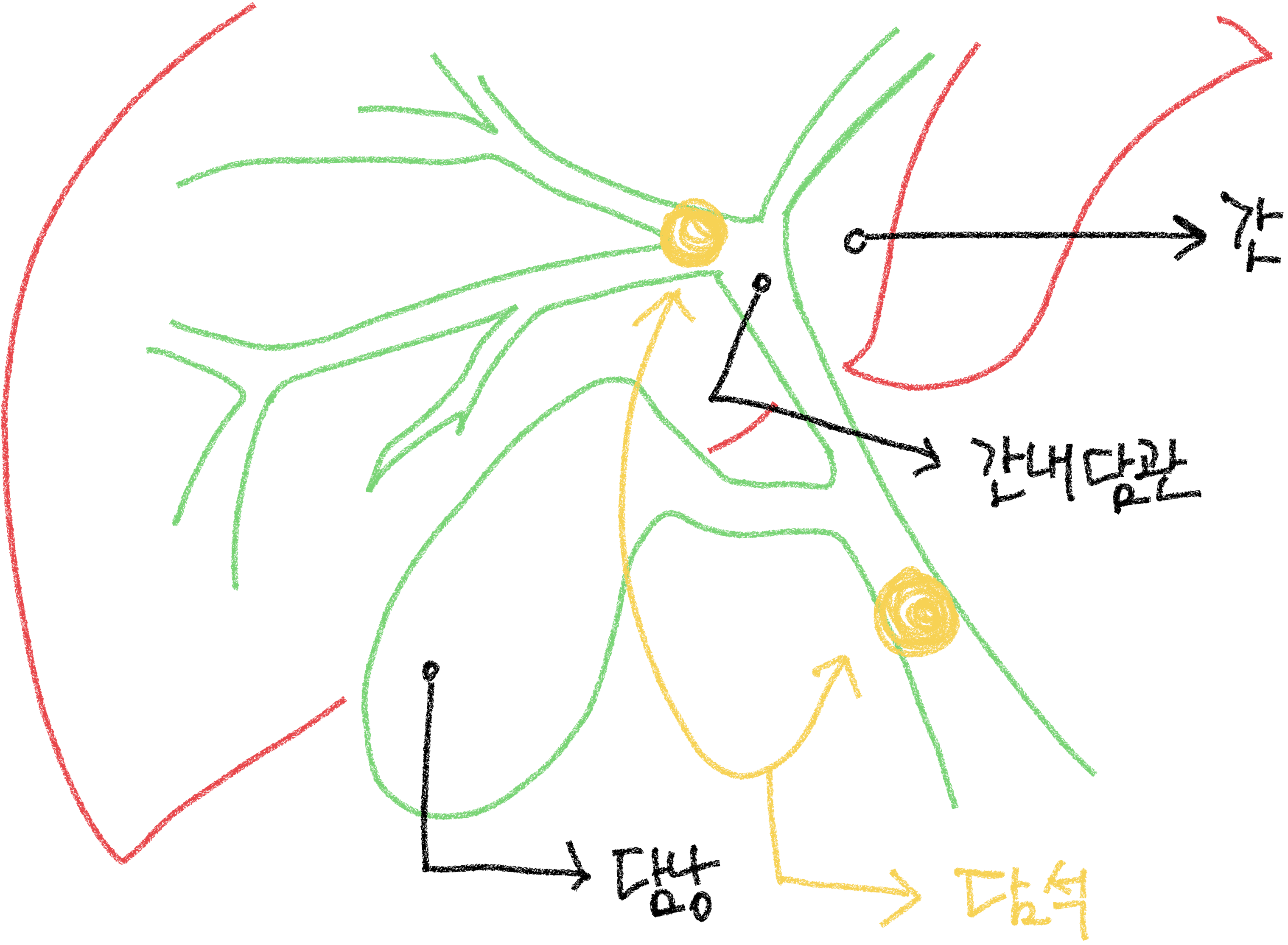 담관 폐쇠 원인 담석