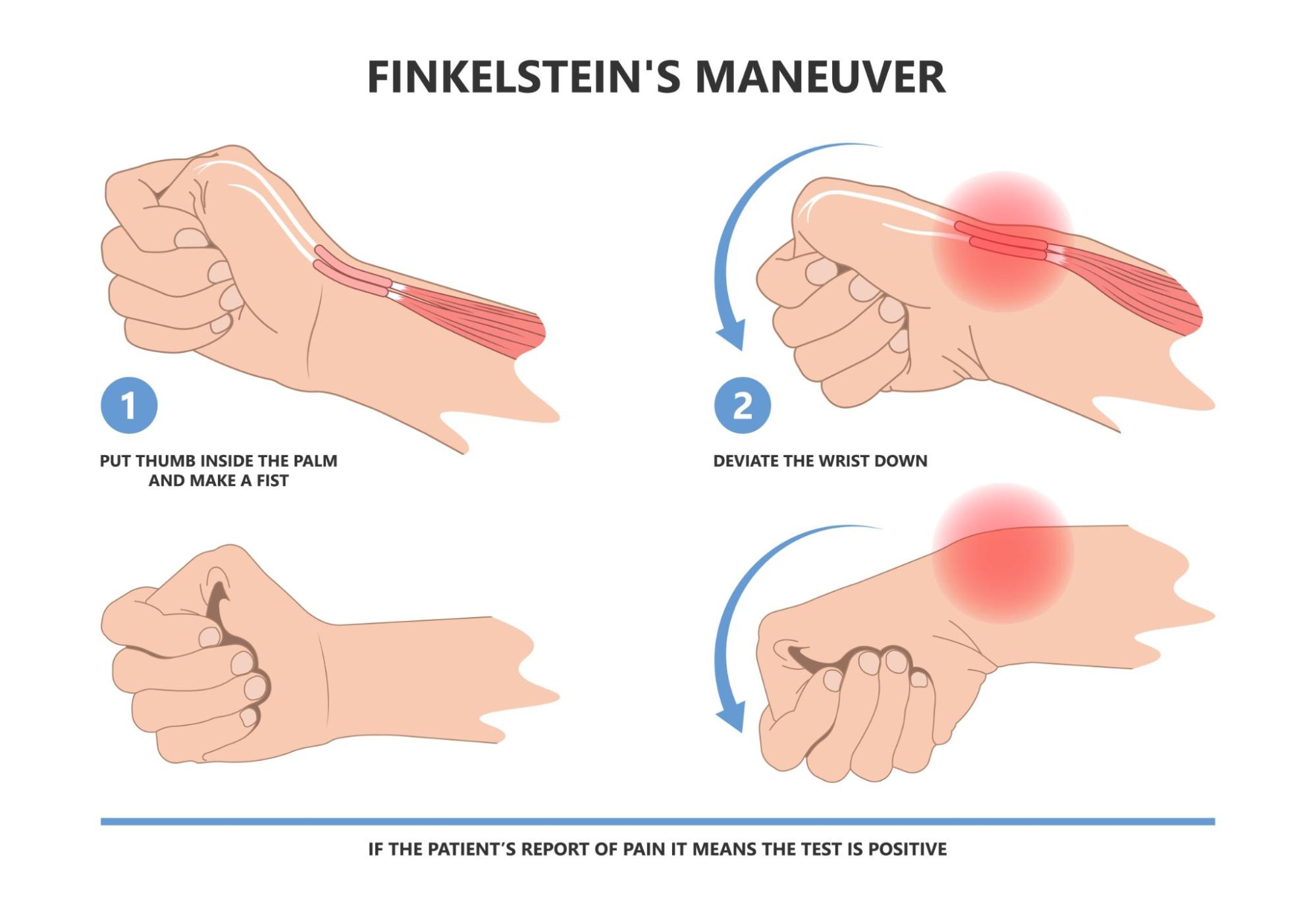 Finkelstein maneuver-드퀘르뱅-dequervain