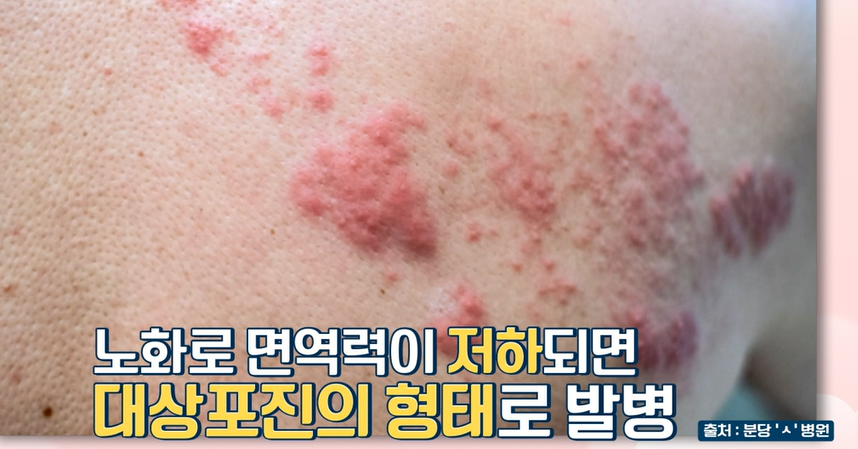 대상포진