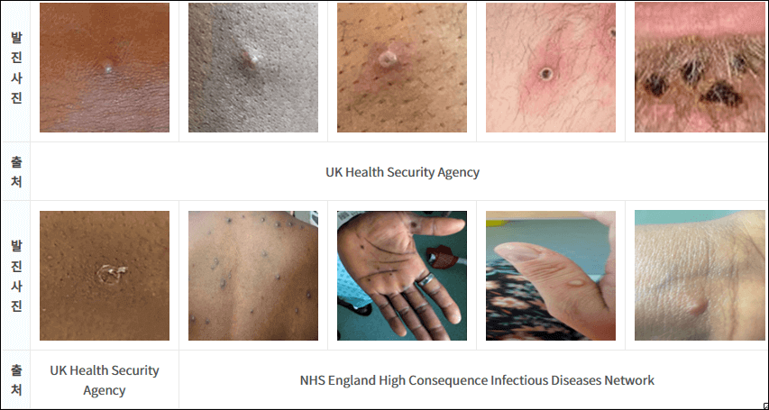 엠폭스 초기 증상