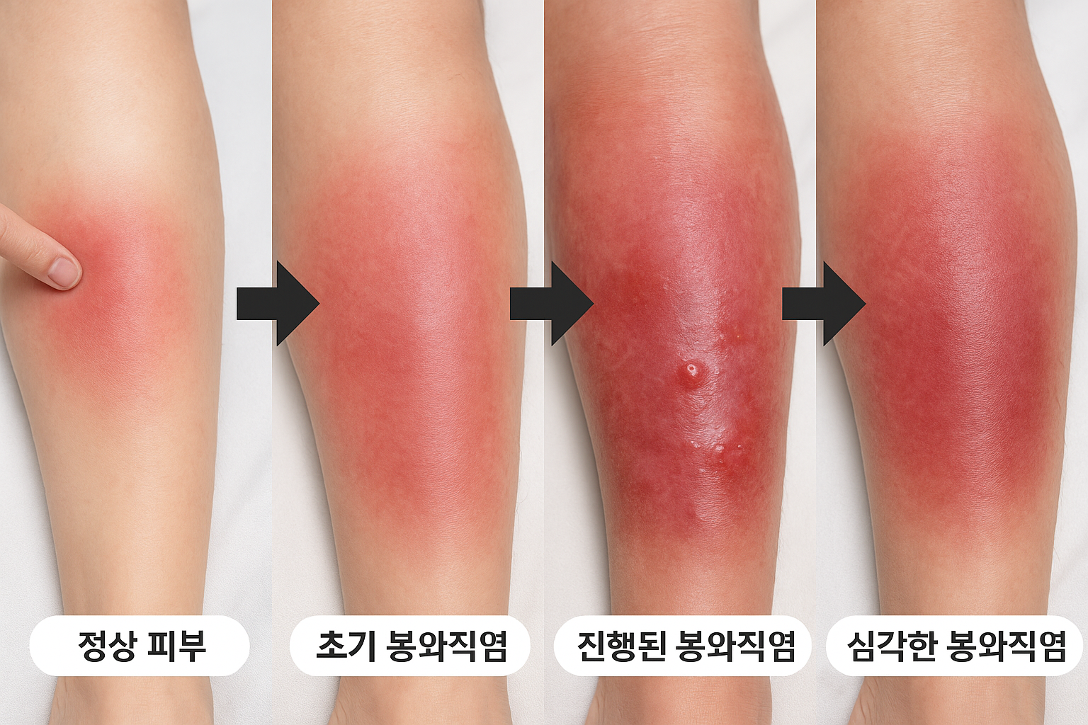 봉와직염 진행과정