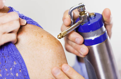 검버섯 액화질소 치료