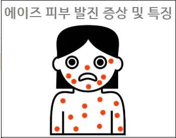 에이즈 피부 발진 증상 및 특징
