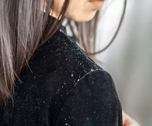 두피 가려움증 원인