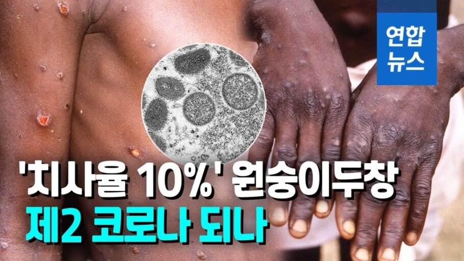 엠폭스 증상