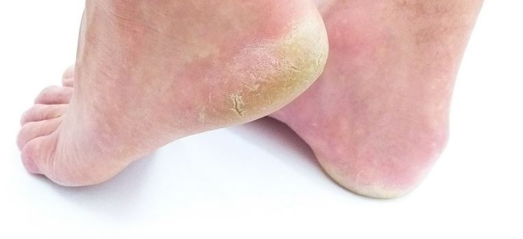 족저근막염증상