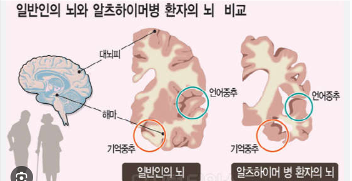 일반인 뇌와 알츠하이머 뇌 비교사진