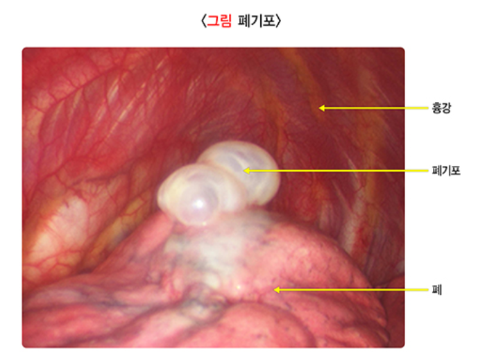 기흉에 대하여