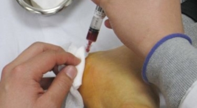 족저근막염 이미지