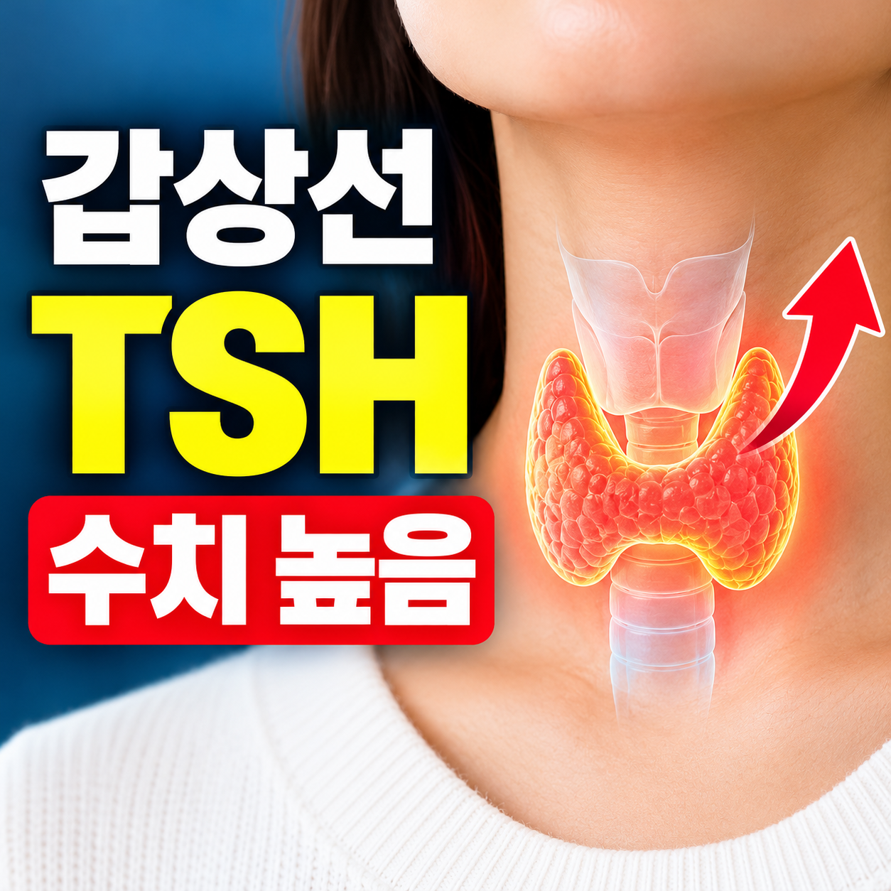 갑상선 TSH 수치 높음