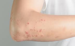 대상포진 초기증상