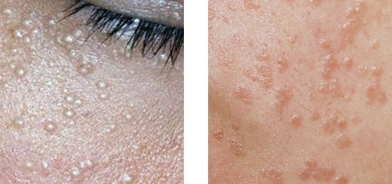 비립종과 편평 사마귀 비교