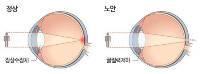노안의 원인은 수정체의 기능 퇴화
