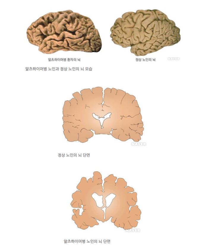 김창옥 알츠하이머 증상