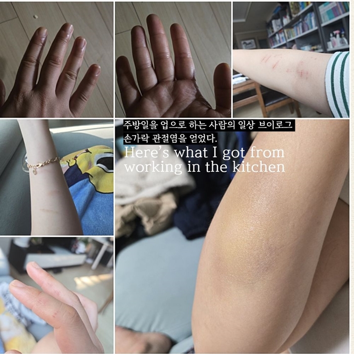 주방일, 손가락 관절염 그리고 다시 살아가고 싶은 마음