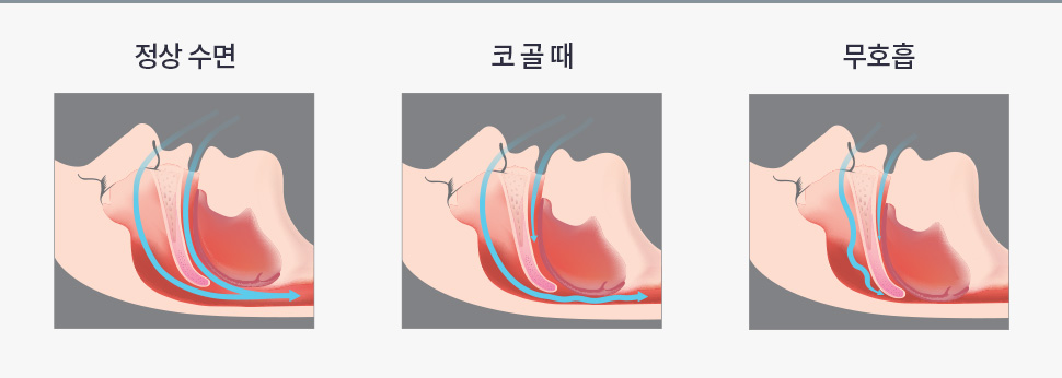 정상수면, 코골때, 무호흡 모습 비교