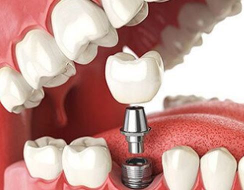 오스템임플란트가격