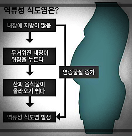 역류성-식도염-과정-및-순서