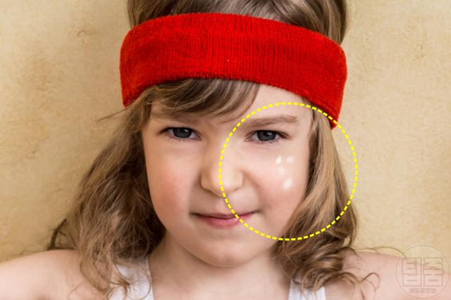 피부에 흰점 생기는 이유 얼굴흰점 원인 백색비강진