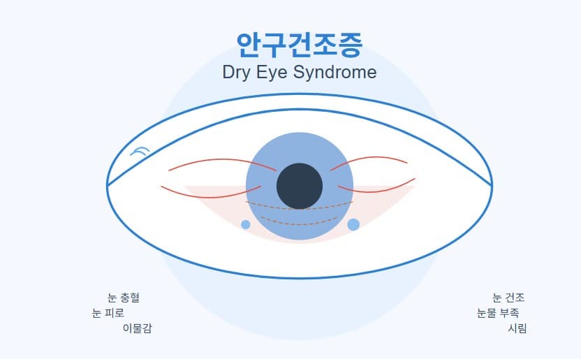 안구건조증 완벽 가이드