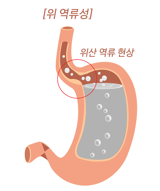 명치통증 원인 위치 역류성 식도염 급체 명치 가슴 통증 예방법